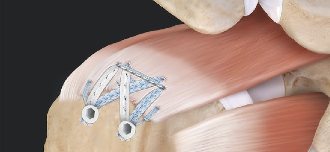 Courtesy of "Stryker" and implant company we often use for rotator cuff repairs 